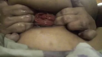 Fisting anal, pussy fist, prolapso anal, pussy prolapse