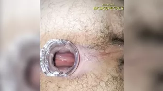 Anal gape with tools. Obgyn speculum inspection.