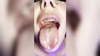 Gag reflex. Drooling and gagging by metal mouth