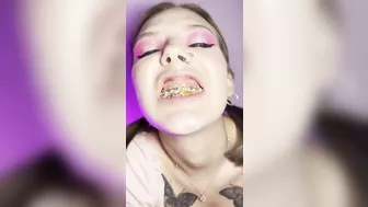 Food crush. Girl with braces chewing food