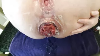 Anal slut gets cock in her huge prolapsed ass