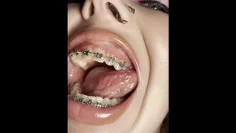 Metal mouth tour. Schoolgirl with braces showing her uvula