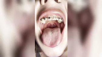 Metal mouth tour. Schoolgirl with braces showing her uvula