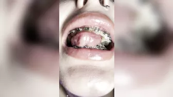 Metal mouth tour. Schoolgirl with braces showing her uvula