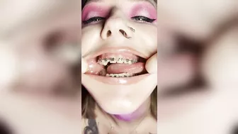 Metal mouth tour. Schoolgirl with braces showing her uvula