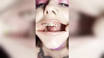 Metal mouth tour. Schoolgirl with braces showing her uvula