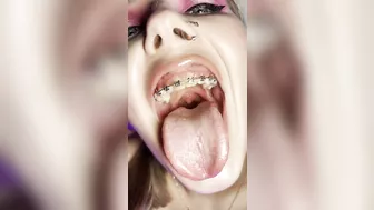 Metal mouth tour. Schoolgirl with braces showing her uvula