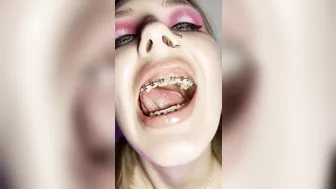 Metal mouth tour. Schoolgirl with braces showing her uvula