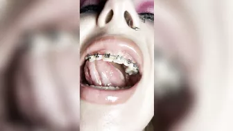 Metal mouth tour. Schoolgirl with braces showing her uvula